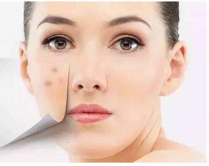 痤疮会传染吗?真相到底是什么?预防唑疮正确