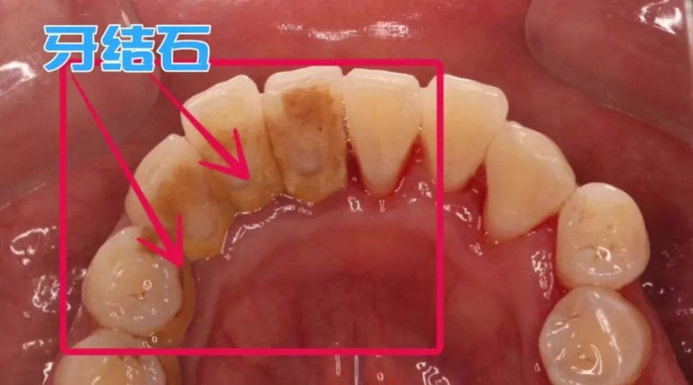 医生,如果对象有牙周炎,接吻会传染给我吗?_腾讯新闻