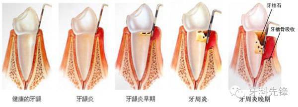 而牙周炎由于牙龈纤维变性破坏,结合上皮向根方增殖而形成牙周袋.