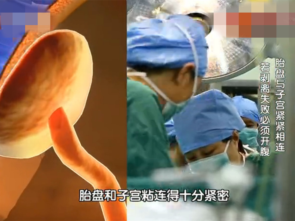 由于胎盘一直取不出来,文霞出现了产后大出血的情况,局面越来越危机