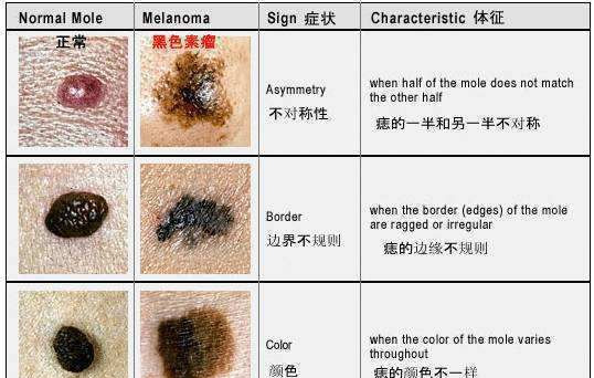 "有痣早治"还是"对痣下药"认识下什么叫做色素痣