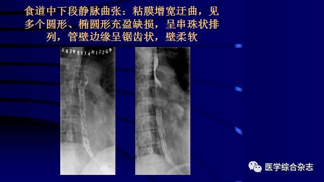 管腔狭窄.   3.管腔内不规则充盈缺损.   4.