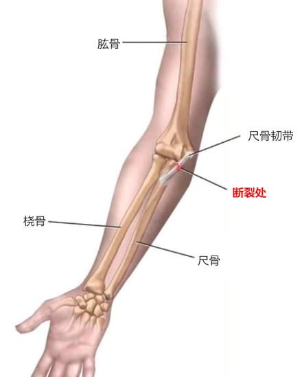梅西伤情解析:非脱臼骨裂只是韧带伤 3周内或