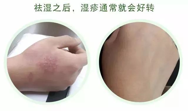 SEO十万个为什么会长湿疹 腾讯网