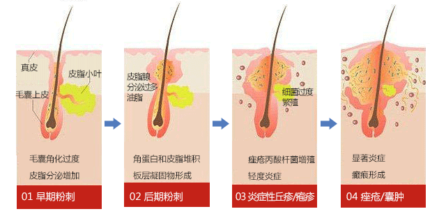 【科普】长痘不是油皮的"专利,干皮,敏感皮也长痘!