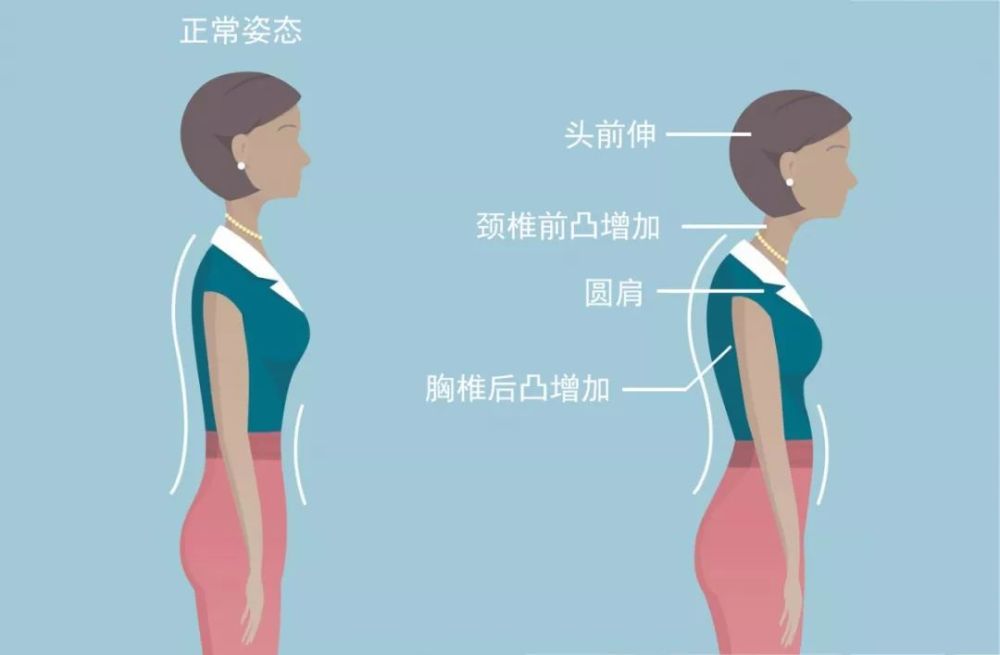 上交叉综合症,即摧毁性影响女性气质的圆肩,驼背,头前伸.