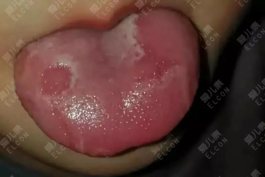 经医生诊断,程程的舌头 是患了游走性舌炎,也就是我们常说的 "地图舌"