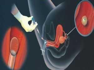 人工授精和试管婴儿都属人工受孕,两者有何不