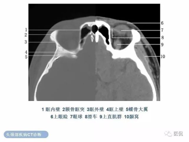 正常眼眶的ct解剖