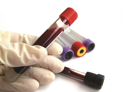 体检发现空腹血糖5.7,餐后2小时15.2,这可能吗