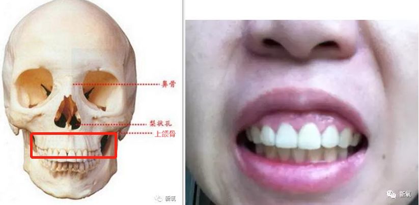 先从嘴凸说起,嘴凸分为齿形和骨性,像下面这样牙齿向外野蛮生长,在箍