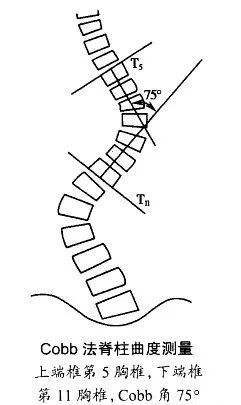 脊柱侧弯康复看这篇值得收藏