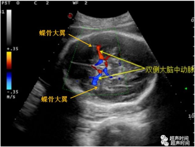 新手福利:胎儿大脑中动脉的测量和评估