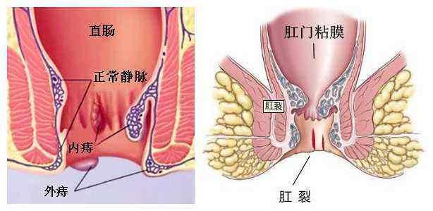 大便有血,痔疮和直肠癌傻傻分不清?肛肠医生教