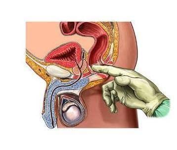 大便有血,痔疮和直肠癌傻傻分不清?肛肠医生教