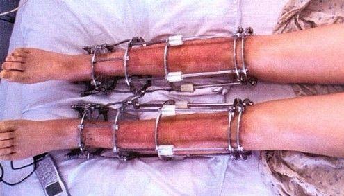 断骨增高术真的可行吗?意外的发现,却伴随高