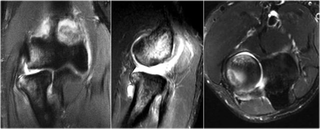 骨科精读|高清:肘关节常见疾病的影像图谱,一文讲透!
