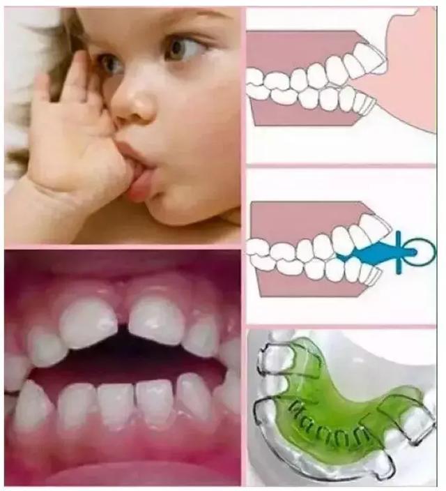 长期频繁吃手竟对宝宝颜值有害,赶紧做正确的