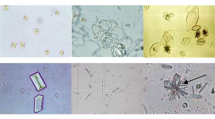 尿液草酸盐过度饱和,是尿结晶颗粒集聚的重要原因,我们日常