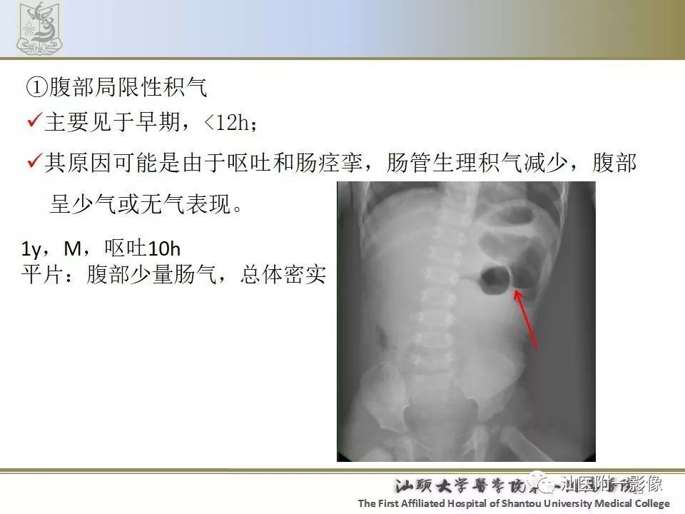 肠套叠的影像表现