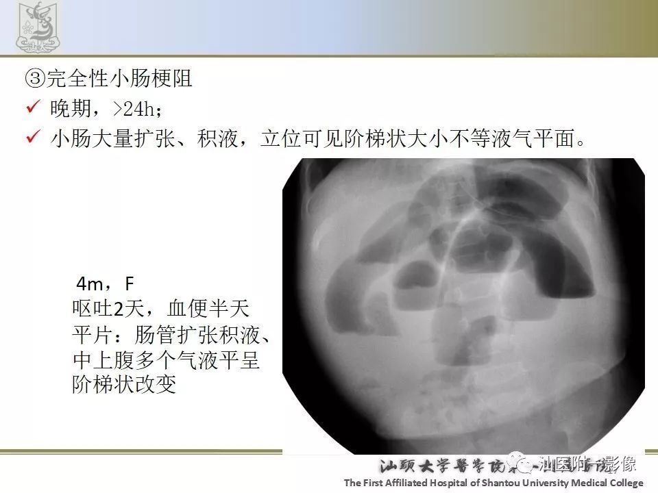 肠套叠的影像表现