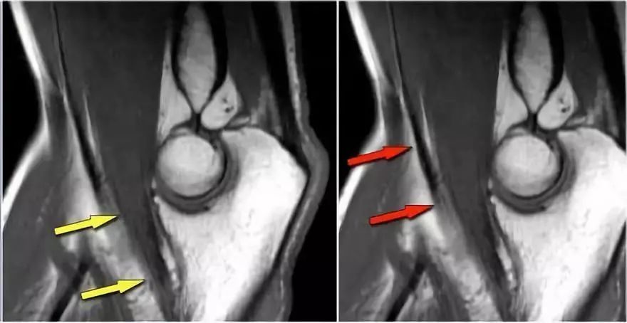 骨科精读高清肘关节常见疾病的影像图谱一文讲透