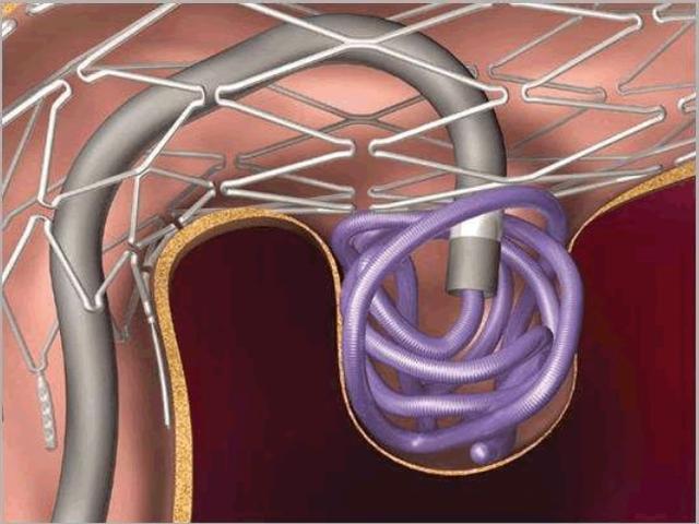 岳阳大叔头痛就医,脑动脉壁现异常膨出,脑动