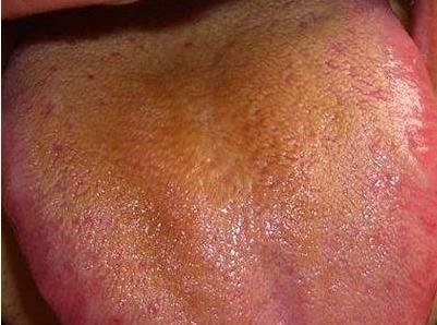 舌苔增厚、全舌发白是身体的什么信号?如何看