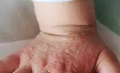 3岁孩子玩了它,手上长满了小疙瘩,这东西小孩