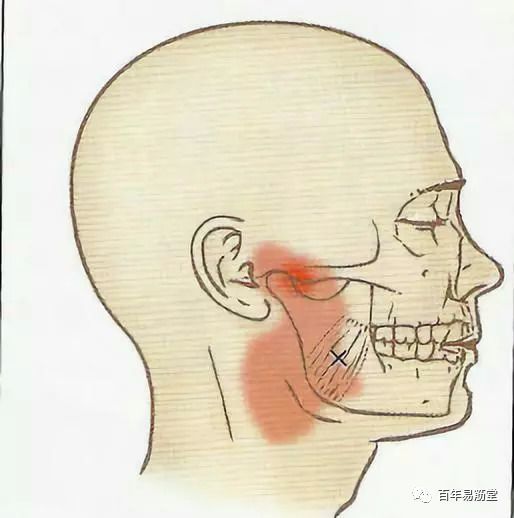 (2)翼内肌上的扳机点容易产生嘴巴(包含舌头)及喉咙的扩散性疼痛,颞