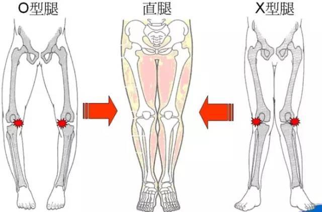 4 先天骨骼的排列不齐,比如膝外翻,或膝内翻,属于先天方面的缺陷.