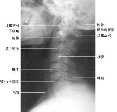 寰齿前关节间隙1~2mm,此间隙延长线的上方为枕骨大孔前缘.