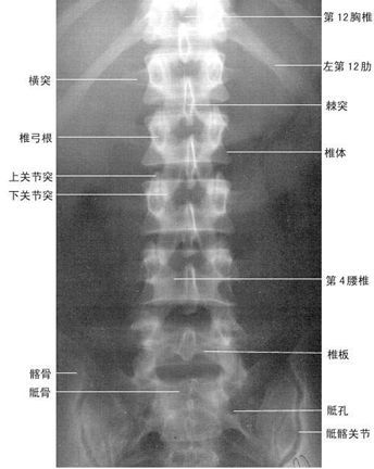 腰椎侧位像椎体呈方形位于前方,后方为椎弓根,相邻的椎弓根上下切迹