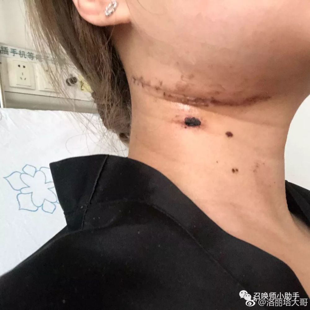 斗鱼洛丽塔整容失败,医生误割大动脉致休克进icu!