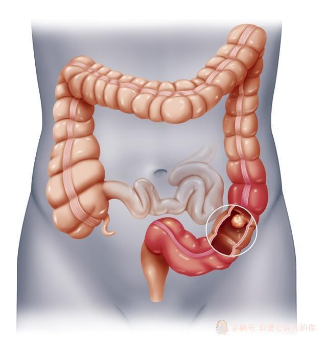 大家想想,这七米到八米的肠子中,哪一小部分生病都会出问题.