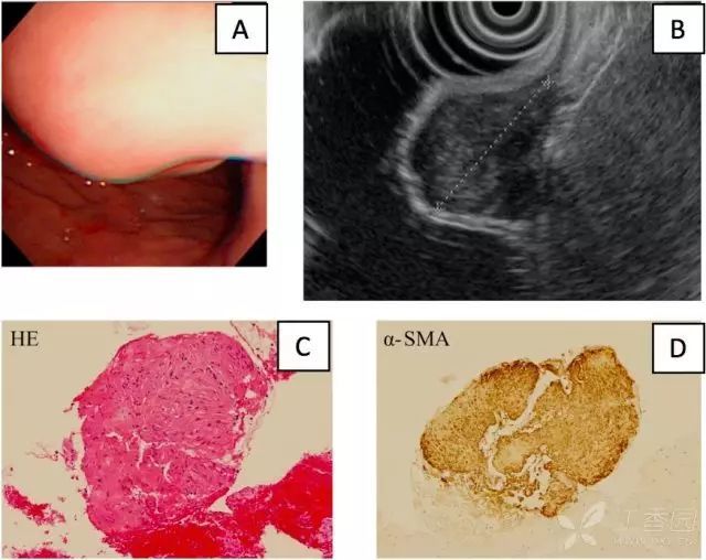 图 3胃平滑肌瘤.