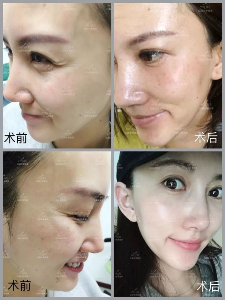 静态皱纹又可分为浅层性细纹和深层皱纹.