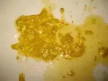黄绿色带粘液,这种大便的出现表明宝宝可能是得了霉菌性肠炎,需要去