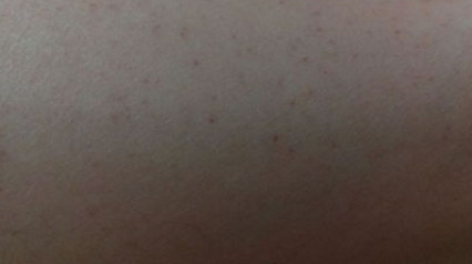 皮肤上出现很多小红点?别紧张,或许跟这几个因