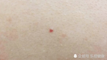皮肤上出现很多小红点?别紧张,或许跟这几个因