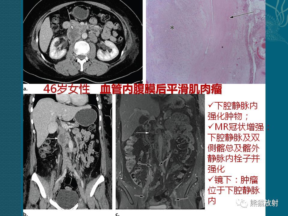 腹膜后平滑肌肉瘤