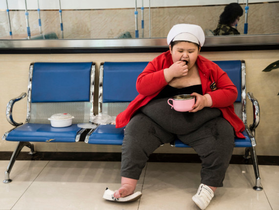 这个男孩患有prader-willi(小胖威利症) 综合症