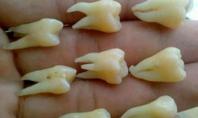 为什么拔出来的智齿会有一股"恶臭味"?你的牙齿还算健康吗?