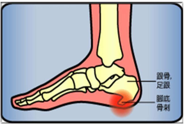 长沙嗲嗲一瘸一拐进门诊,脚底不红不肿就是痛,长了根"刺"