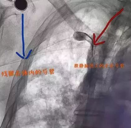 picc拔管时竟发生断裂!这些处理方法一定要知道