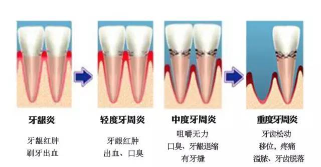 helen齿科中心牙周炎的危害