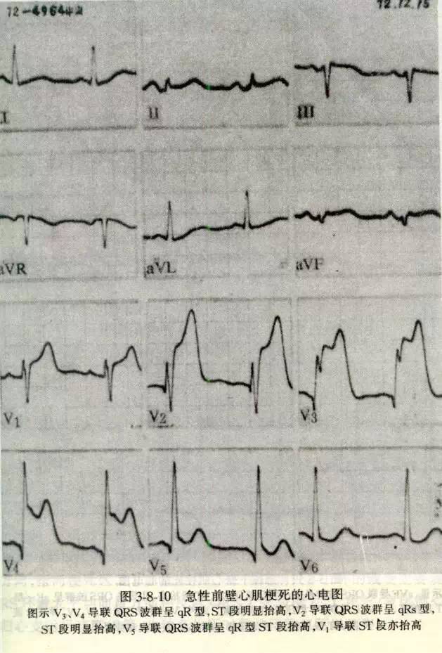 前间壁:v1,v2,v3(三),心肌梗死的定位诊断近年来,对急性心肌梗死实施