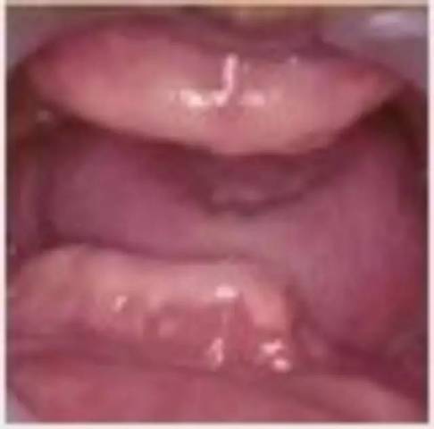 19岁少女只因喜欢吃这种东西,舌头被割了!