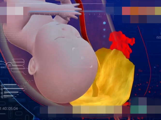 高龄女性怀二胎,胚胎着床在剖腹产刀口,结局让