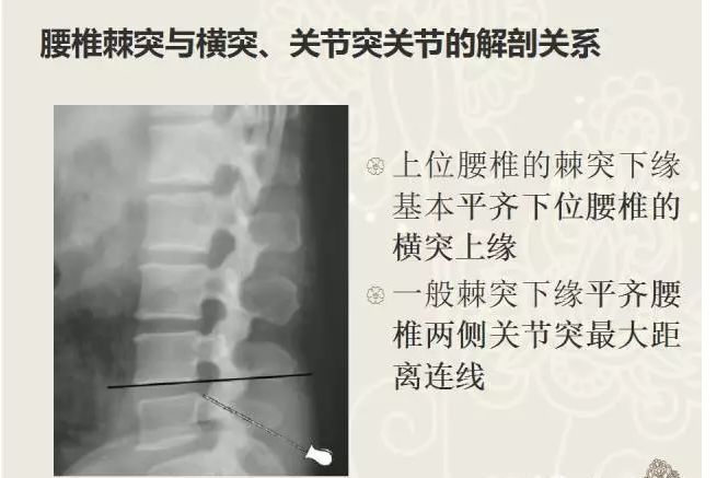 腰椎棘突在针刀定位治疗中的应用